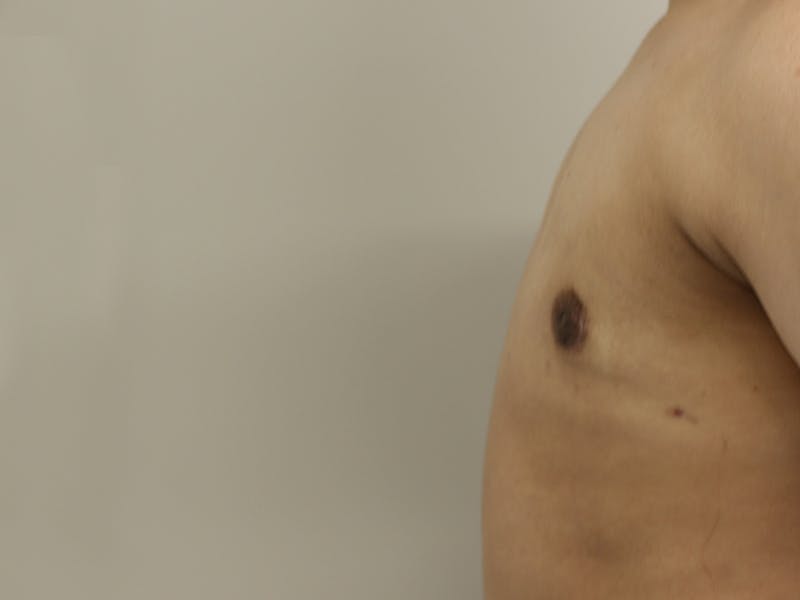 Top Surgery Before & After Gallery - Patient 280081 - Image 4
