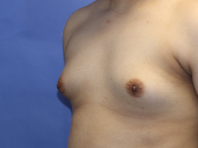 Top Surgery Before & After Gallery - Patient 280081 - Image 5