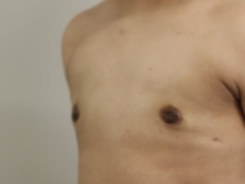 Top Surgery Before & After Gallery - Patient 280081 - Image 6