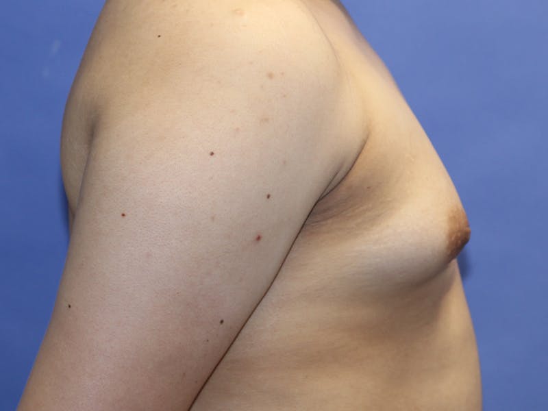 Top Surgery Before & After Gallery - Patient 280081 - Image 7