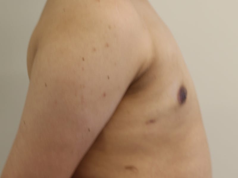 Top Surgery Before & After Gallery - Patient 280081 - Image 8