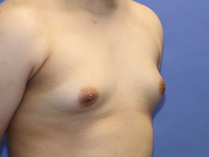 Top Surgery Before & After Gallery - Patient 280081 - Image 9