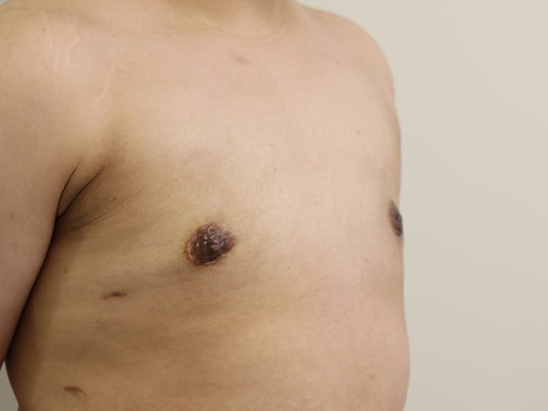 Top Surgery Before & After Gallery - Patient 280081 - Image 10