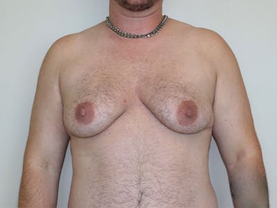 Top Surgery Before & After Gallery - Patient 158418 - Image 1