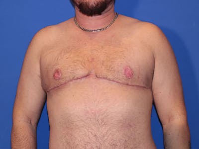 Top Surgery Before & After Gallery - Patient 158418 - Image 2