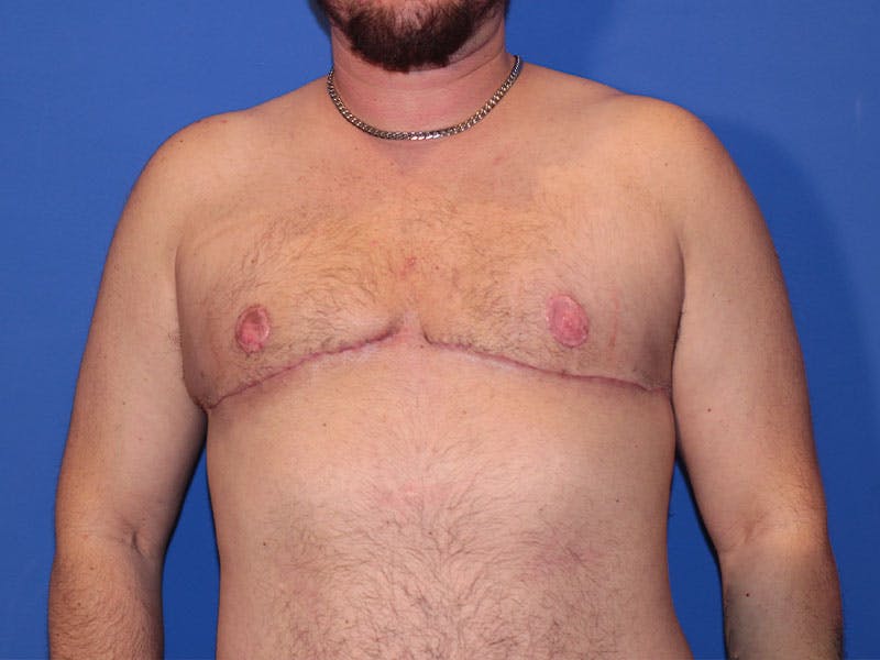 Top Surgery Before & After Gallery - Patient 158418 - Image 2
