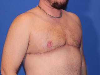 Top Surgery Before & After Gallery - Patient 158418 - Image 4