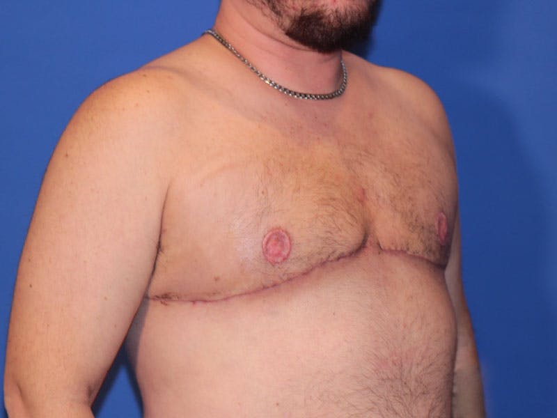 Top Surgery Before & After Gallery - Patient 158418 - Image 4