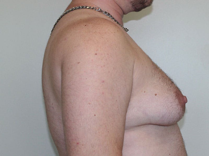 Top Surgery Before & After Gallery - Patient 158418 - Image 5