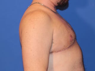 Top Surgery Before & After Gallery - Patient 158418 - Image 6