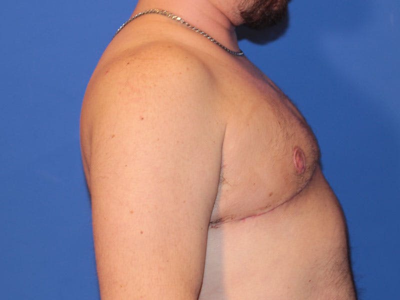 Top Surgery Before & After Gallery - Patient 158418 - Image 6