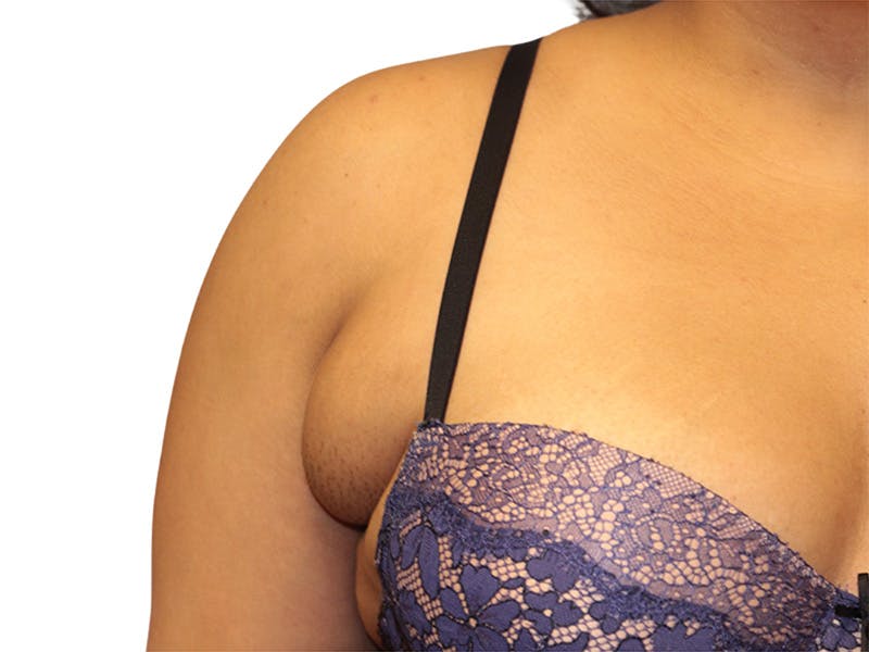 Side Breast Tissue Removal Before & After Gallery - Patient 142680 - Image 1