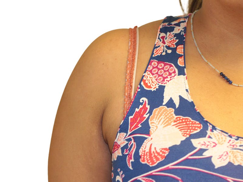 Side Breast Tissue Removal Before & After Gallery - Patient 142680 - Image 2