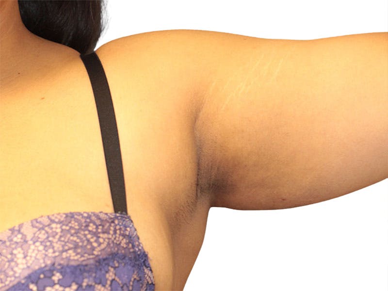 Side Breast Tissue Removal Before & After Gallery - Patient 142680 - Image 3