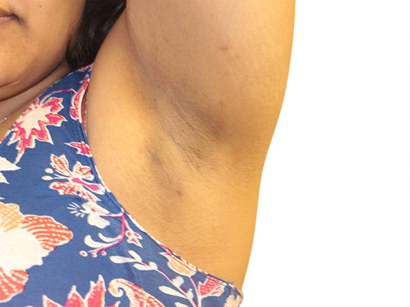 Side Breast Tissue Removal Before & After Gallery - Patient 142680 - Image 4