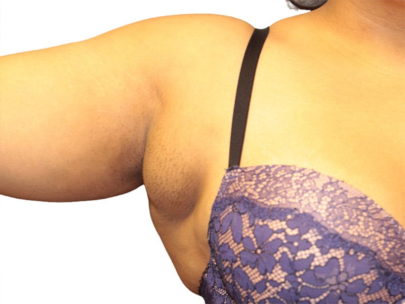 Side Breast Tissue Removal Before & After Gallery - Patient 142680 - Image 5