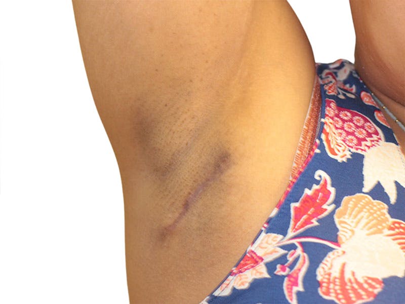 Side Breast Tissue Removal Before & After Gallery - Patient 142680 - Image 6