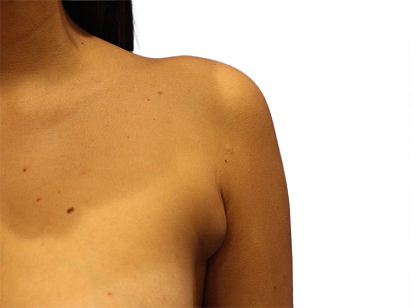Side Breast Tissue Removal Before & After Gallery - Patient 578288 - Image 1
