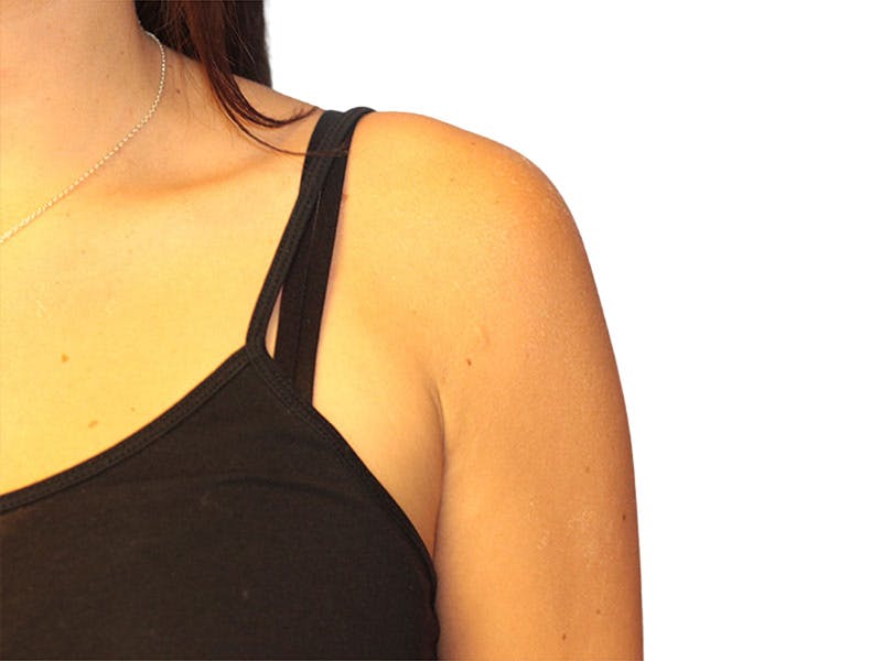 Side Breast Tissue Removal Before & After Gallery - Patient 578288 - Image 2