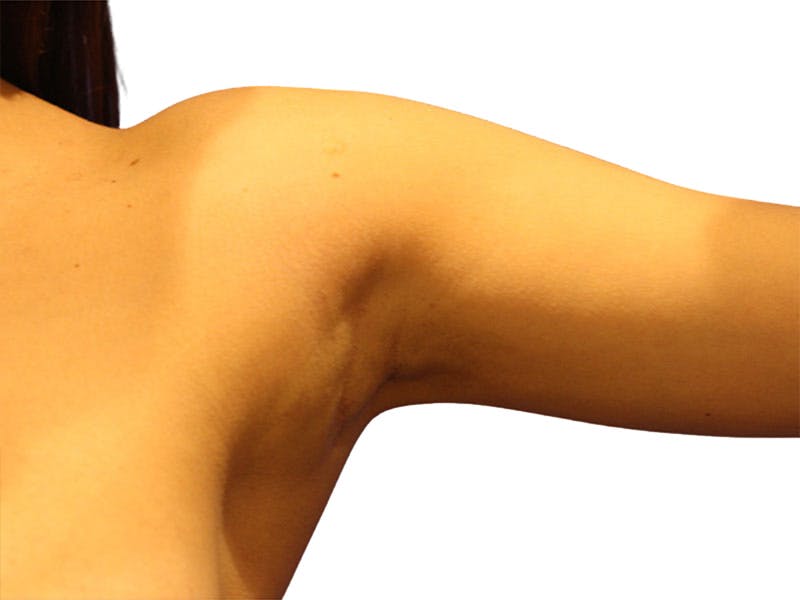 Side Breast Tissue Removal Before & After Gallery - Patient 578288 - Image 3