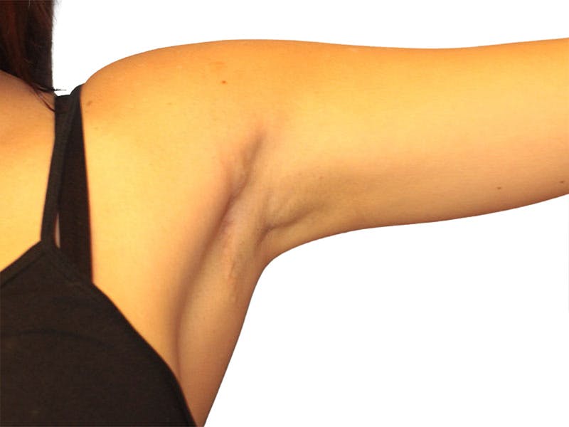 Side Breast Tissue Removal Before & After Gallery - Patient 578288 - Image 4