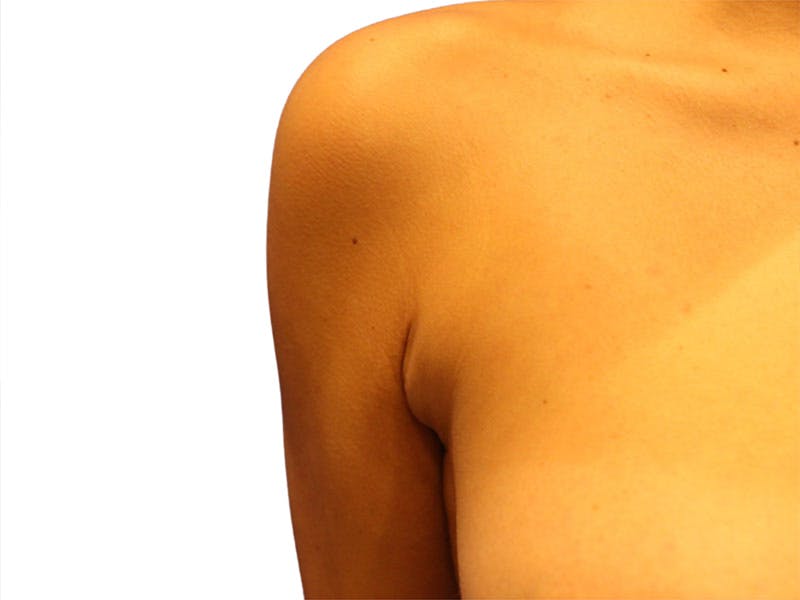 Side Breast Tissue Removal Before & After Gallery - Patient 578288 - Image 5