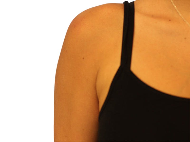 Side Breast Tissue Removal Before & After Gallery - Patient 578288 - Image 6