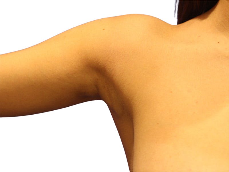 Side Breast Tissue Removal Before & After Gallery - Patient 578288 - Image 7
