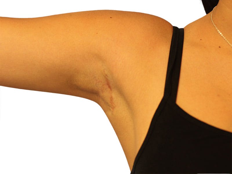 Side Breast Tissue Removal Before & After Gallery - Patient 578288 - Image 8