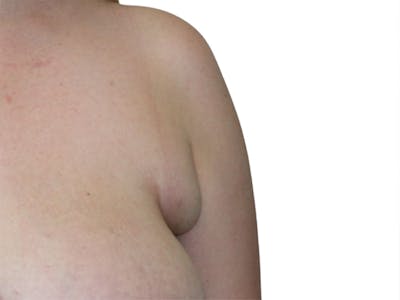 Side Breast Tissue Removal Before & After Gallery - Patient 511197 - Image 1