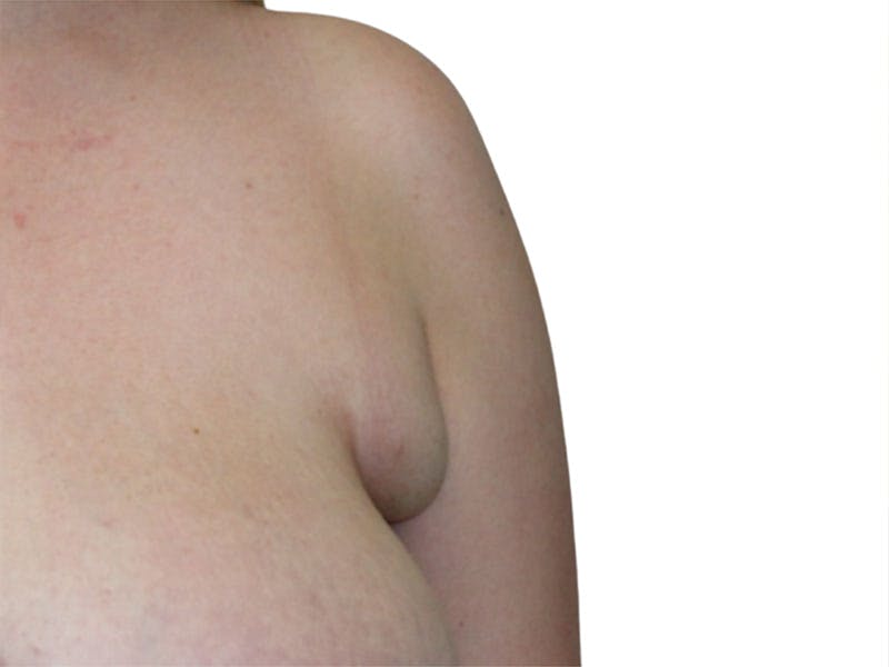 Side Breast Tissue Removal Before & After Gallery - Patient 511197 - Image 1