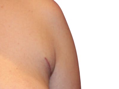 Side Breast Tissue Removal Before & After Gallery - Patient 511197 - Image 2