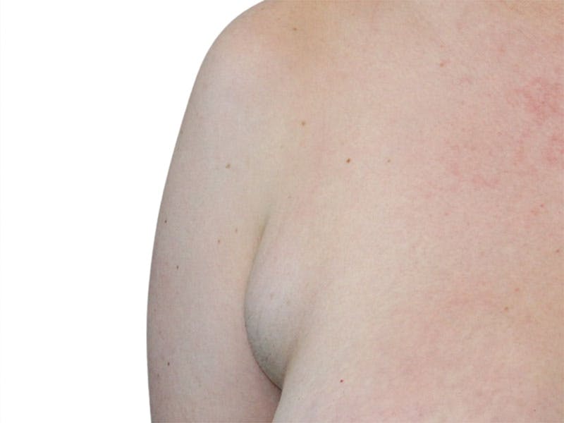 Side Breast Tissue Removal Before & After Gallery - Patient 511197 - Image 3