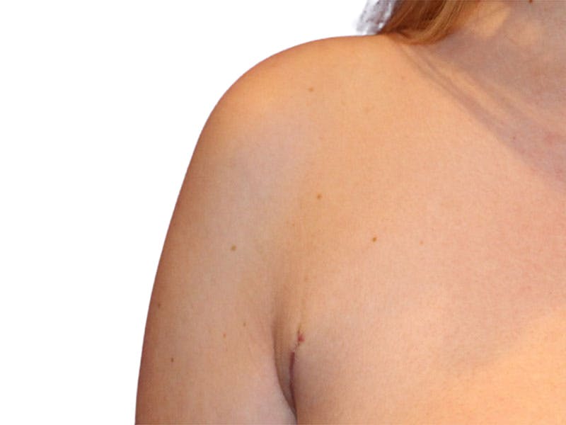 Side Breast Tissue Removal Before & After Gallery - Patient 511197 - Image 4