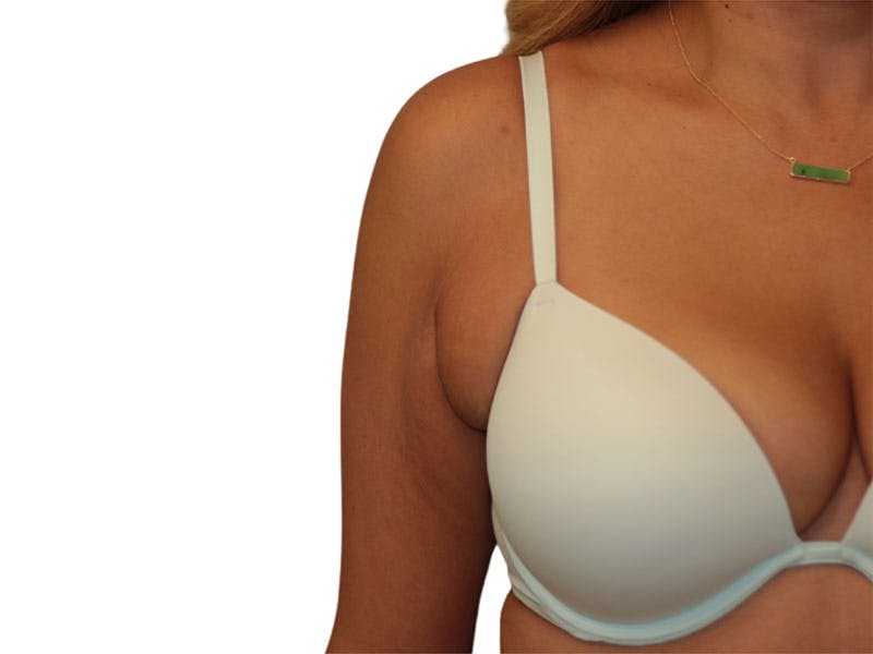 Side Breast Tissue Removal Before & After Gallery - Patient 393518 - Image 1