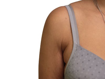 Side Breast Tissue Removal Before & After Gallery - Patient 393518 - Image 2
