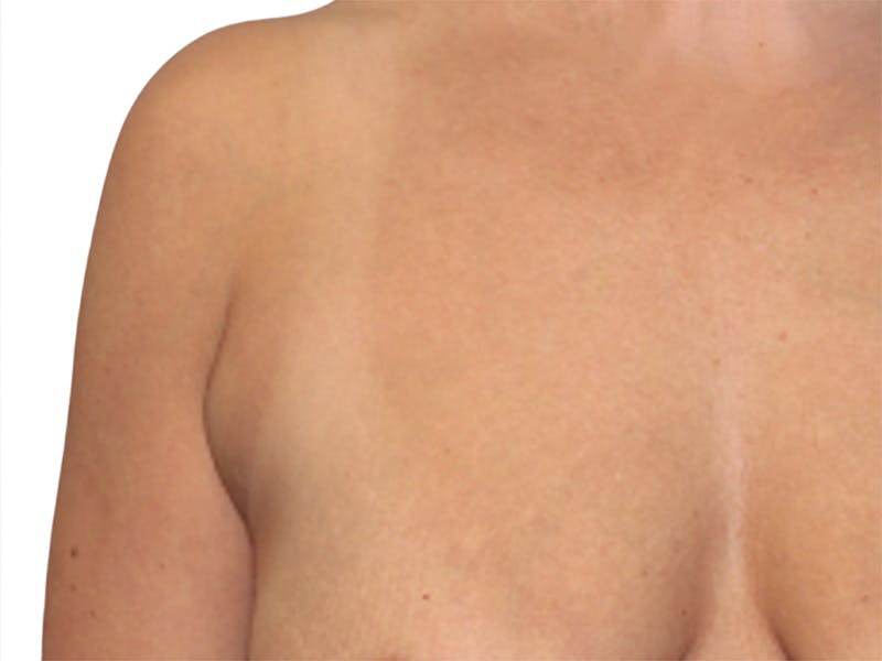 Side Breast Tissue Removal Before & After Gallery - Patient 239918 - Image 1