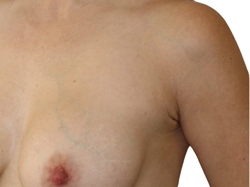Side Breast Tissue Removal Before & After Gallery - Patient 239918 - Image 6