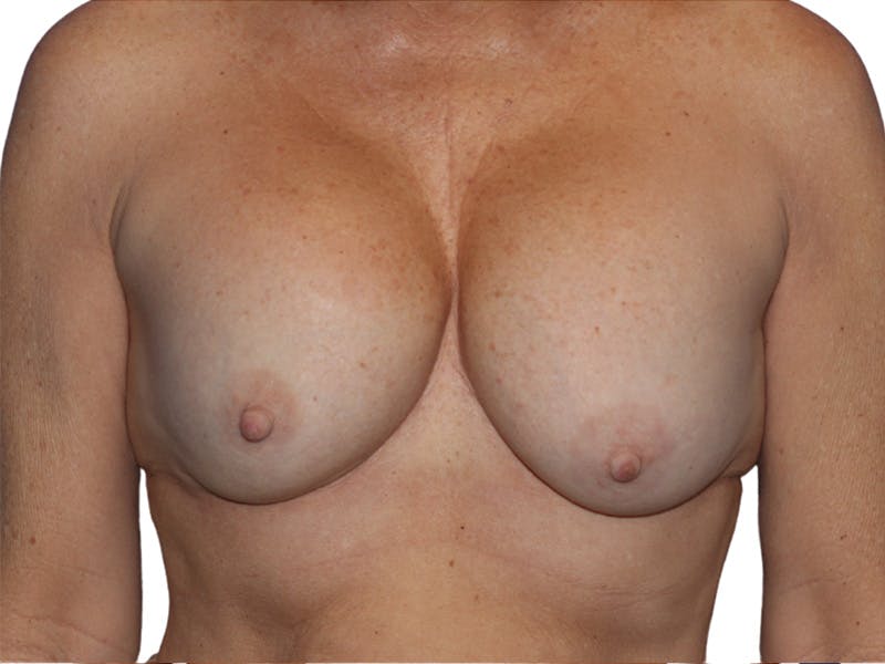 Breast Revisions Before & After Gallery - Patient 158678 - Image 1