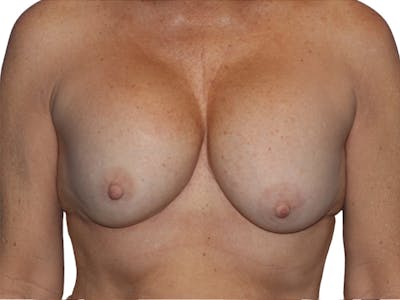Breast Revisions Before & After Gallery - Patient 158678 - Image 1