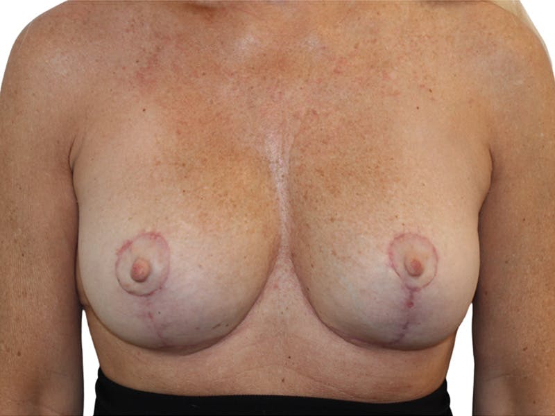Breast Revisions Before & After Gallery - Patient 158678 - Image 2