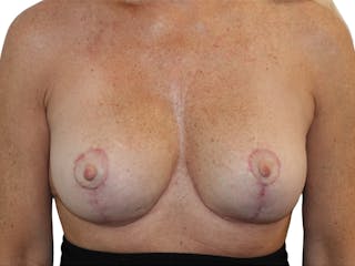 Breast Revisions Before & After Gallery - Patient 158678 - Image 2
