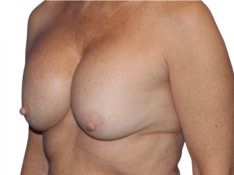 Breast Revisions Before & After Gallery - Patient 158678 - Image 3