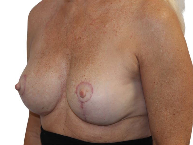 Breast Revisions Before & After Gallery - Patient 158678 - Image 4