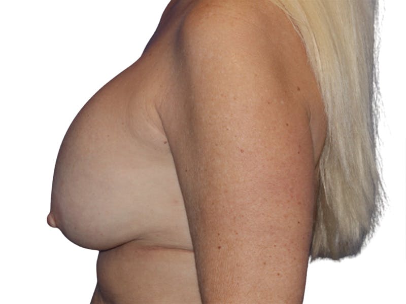 Breast Revisions Before & After Gallery - Patient 158678 - Image 5