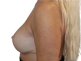 Breast Revisions Before & After Gallery - Patient 158678 - Image 6