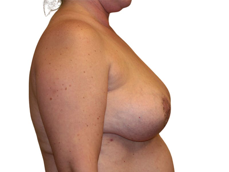 Breast Revisions Before & After Gallery - Patient 285149 - Image 2