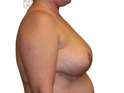 Breast Revisions Before & After Gallery - Patient 285149 - Image 2