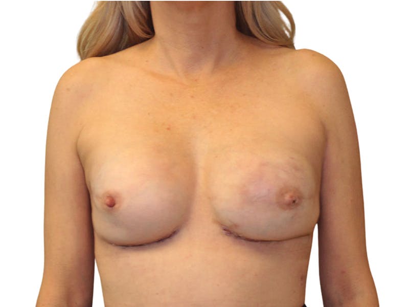 Breast Revisions Before & After Gallery - Patient 284886 - Image 2