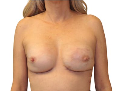 Breast Revisions Before & After Gallery - Patient 284886 - Image 2